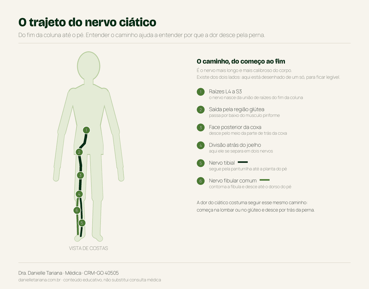 Trajeto do nervo ciático, das raízes L4 a S3 até o pé, com a divisão em nervo tibial e nervo fibular comum
