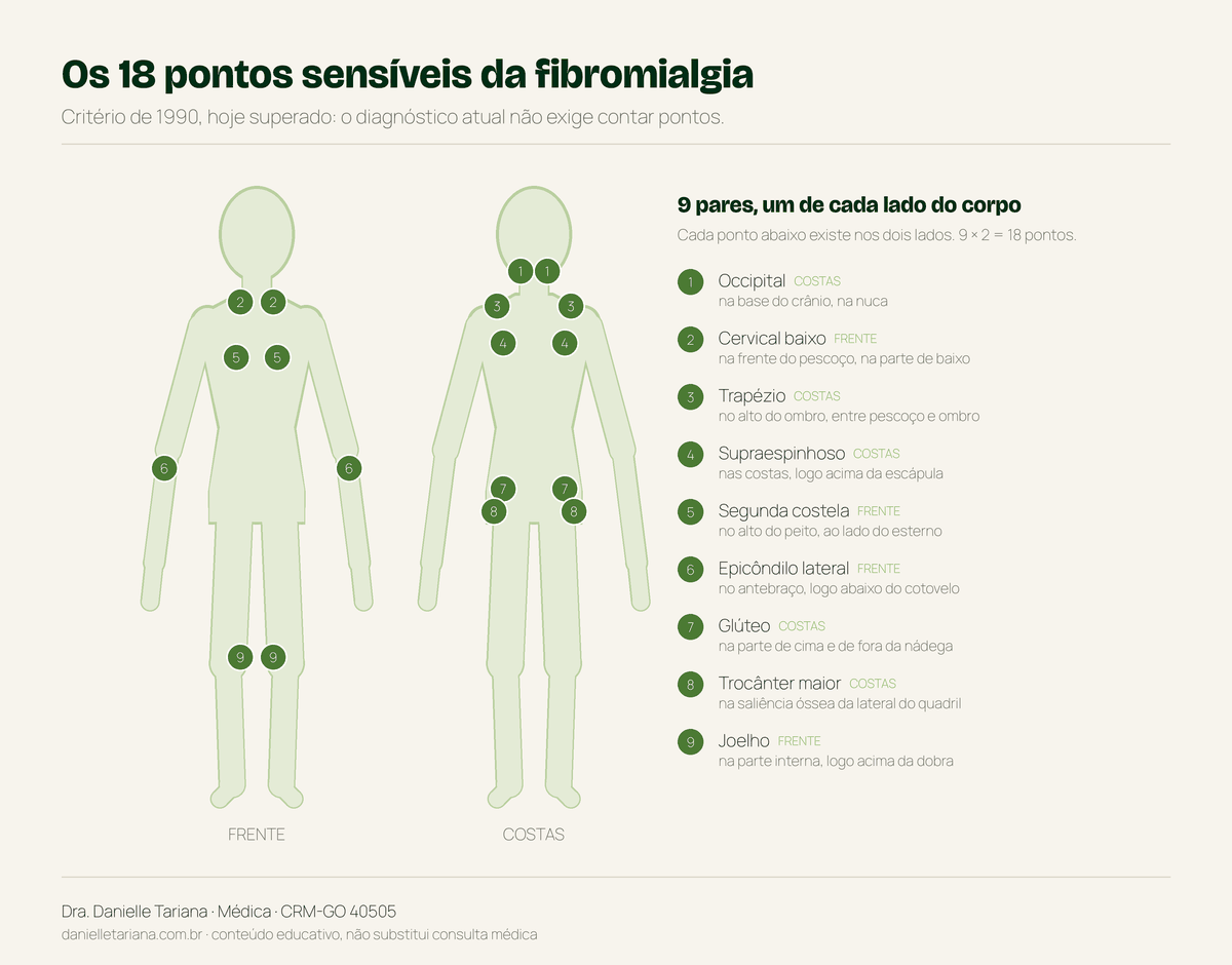 Mapa dos 18 pontos sensíveis do critério de 1990 para fibromialgia, nas vistas de frente e de costas